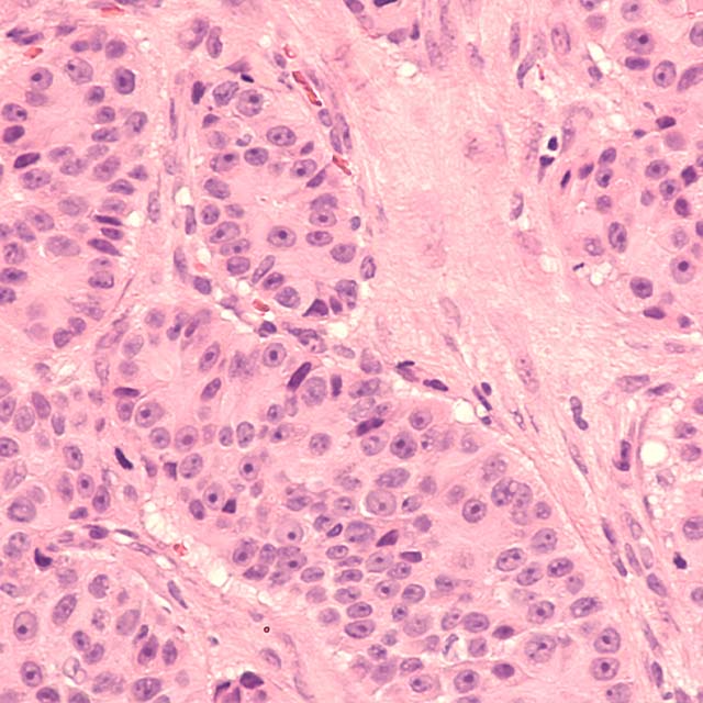 biopsy of prostate gland showing histology of prostatic adenocarcinoma with prominent nucleoli in patient with elevated prostate-specific antigen (PSA).