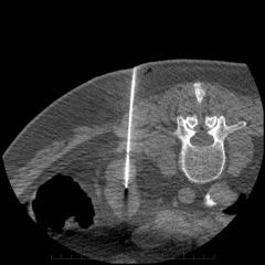 Renal ablation, Health Economics and Cost-effectiveness in Interventional Radiology